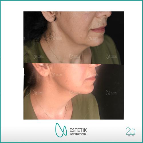 Before after photos of our patients 8